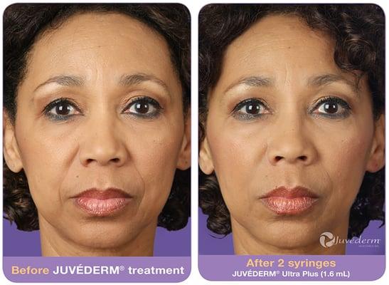 Juvederm® was given to this patient to drastically reduce frown lines around the mouth!