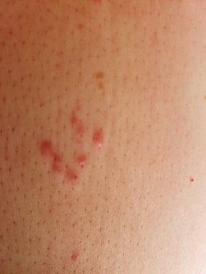 Bed bug bites