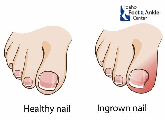 A common ailment, ingrown toenails can be painful.  We can help!