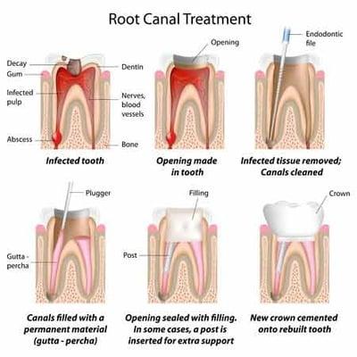 Root canal treatments - which can remove the infected pulp and nerve tissue from inside your tooth - can save your tooth and your smile.