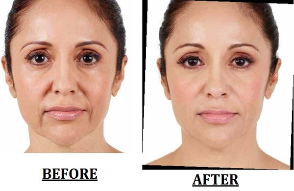 Beautiful facial makeovers with Botox and Fillers!