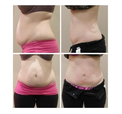 Results from a client who lost 30lbs on the Medical Weight Loss Program and over 16inches with Strawberry Laser Lipo!