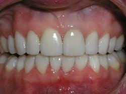 After Full mouth dental reconstruction