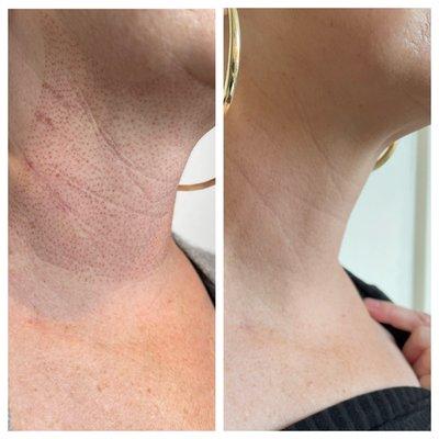 Healing progress 6 days after Plasma Fibroblast to neck.