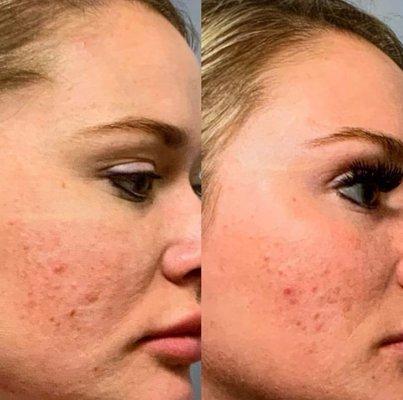 Acne be gone! Second round of microneedling This procedure usually takes 10-20 minutes and around 4-6 treatments.