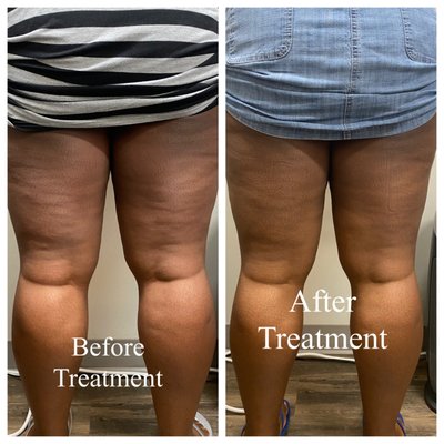 Skin Tightening treatment. Diminishes cellulite, and tightens the skin.