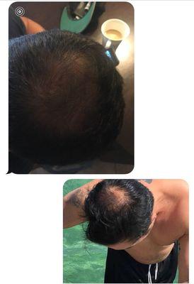 Before on bottom. The top pic is taken after three weeks of treatment.