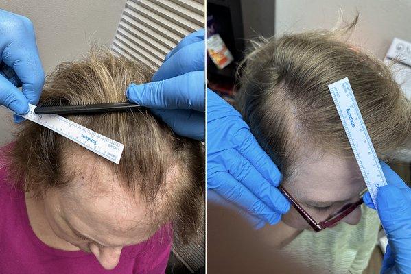 Our women's hair regrowth team has over 15 years of regenerative experience in PBC hair restoration...