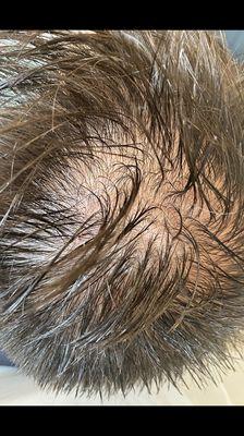 Hair restoration with PRP