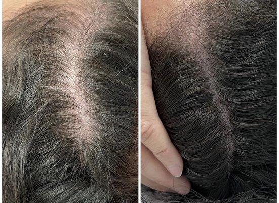 Treatment: PRP Hair Restoration