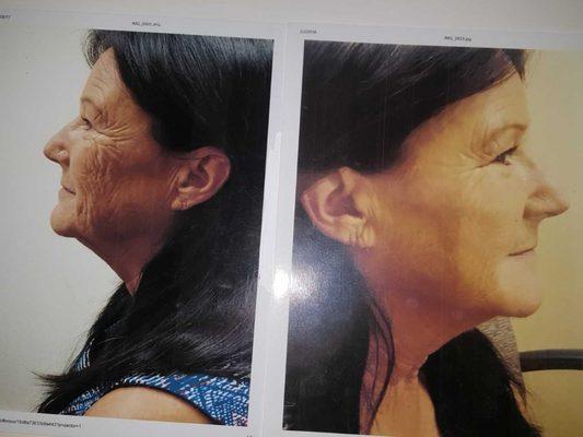 Before and after non surgical facelift