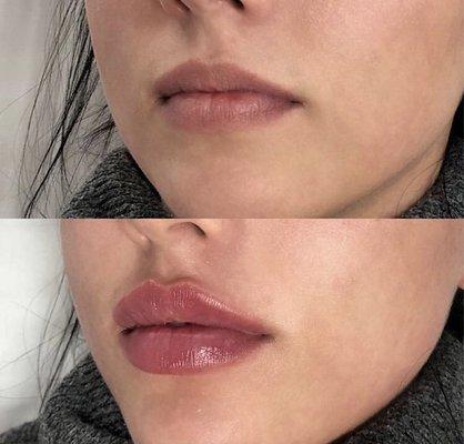 Beautiful before and after using Juvaderm filler. Minimal to no swelling