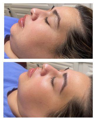 Before & after Deluxe Hydroglow Treatment