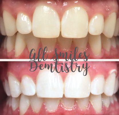 We do Laser Teeth Whitening and have great results!!