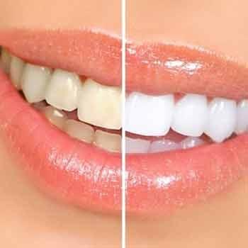 Whiten teeth by 3-5 shades in 1 office visit. We use the powerful yet safe Sapphire system which emits no UV rays.