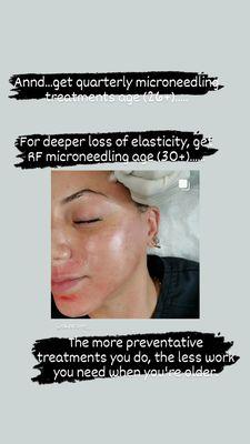 Microneedling procedure for scars and anti aging