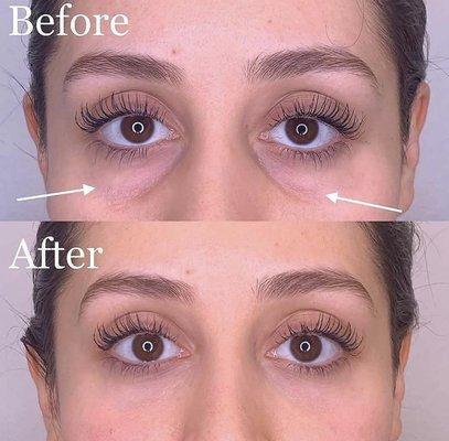 Undereye Fillers