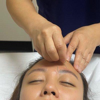 Facial rejuvenation acupuncture is defintely an effective way to look and feel better without looking like you had work "done".