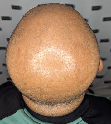 Here is a solid Norwood 7 pattern baldness - Before