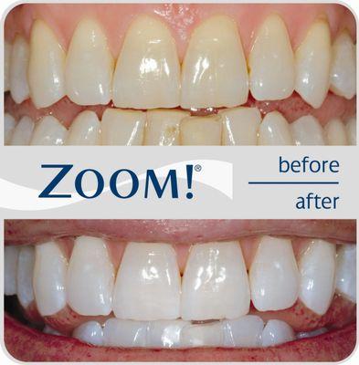 We offer in-office Zoom whitening and take home trays as well