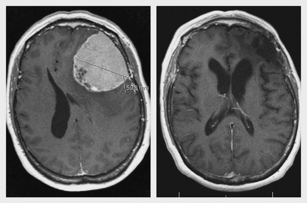 Before and After: More than 3 Years after Resection of her tumor, this patient remains both symptom-free and tumor-free!