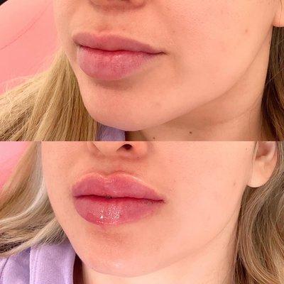 Lip fillers