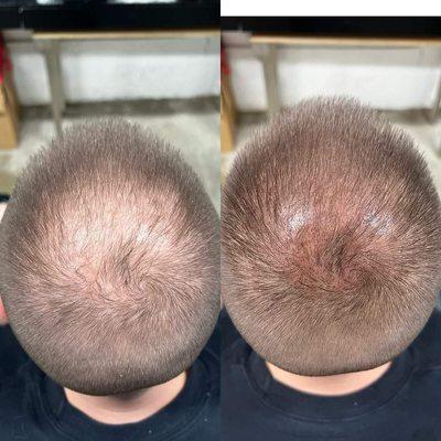 Scalp micropigmentation for density