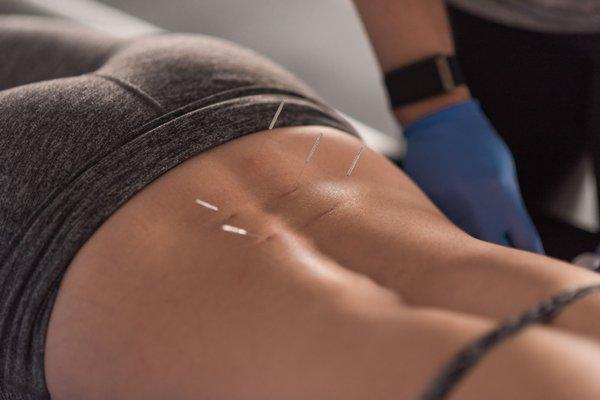 Dry Needling