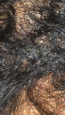 Chemical burn from relaxer on scalp on back, left side