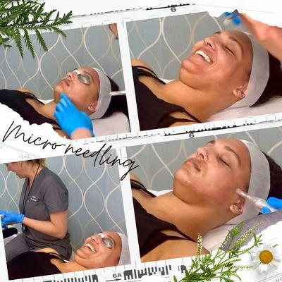 Micro needling treatment