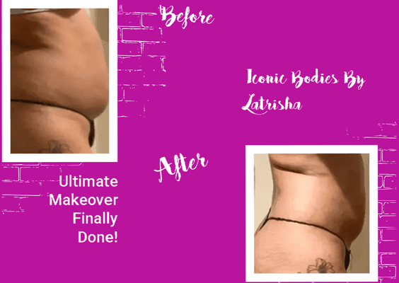 Results After 3 Sessions of Lipo Cavitation/Laser Lipo/ Ems Treatments