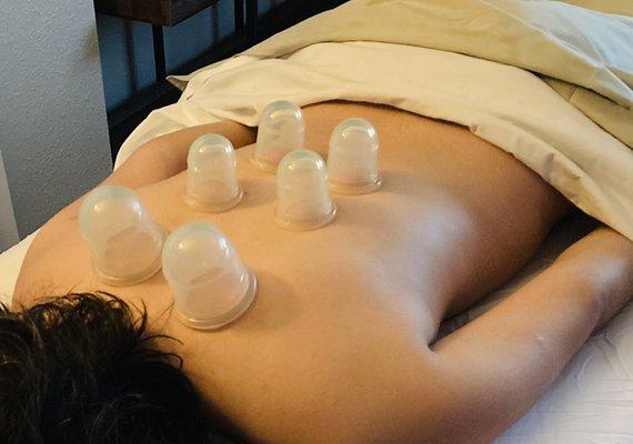 Cupping