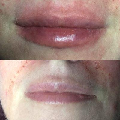 Before and after lip augmentation