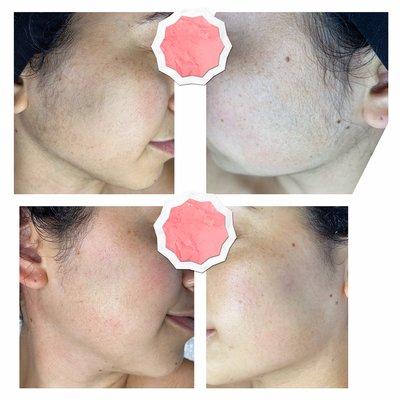 Brightening dermaplane facial