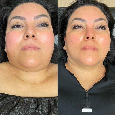 Chin reduction THREE session!