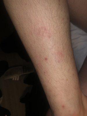 bed bug bites