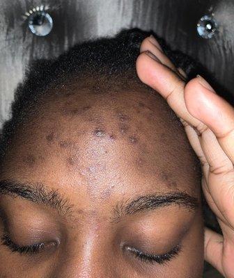 Before Month 2 in acne facial