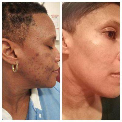 The picture to your left is before I met Audrey. The picture to the right is after receiving skin care treatment.