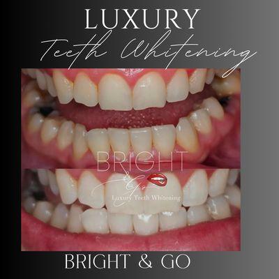 Bright & Go Mobile Teeth Whitening