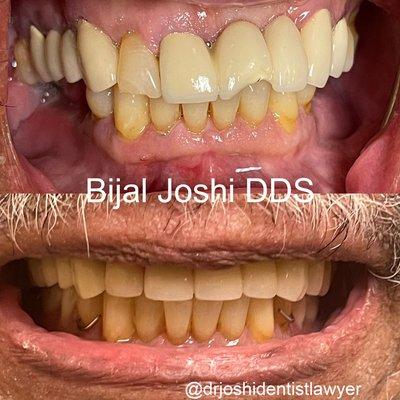 Restored patients bite and gave him cosmetic results!  Patient can eat and smile with confidence!!!