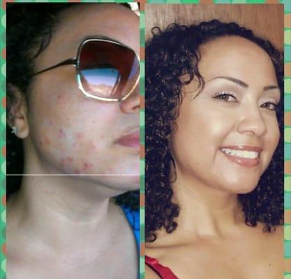 Skincare /peels/microdermabrasion