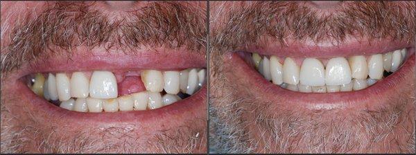 New Smile with Dental Implant!