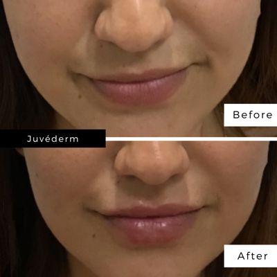 Before and after Juvéderm in lips.