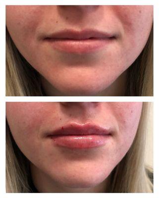 Lip filler before and after