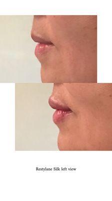 Before and immediately after Restylane silk