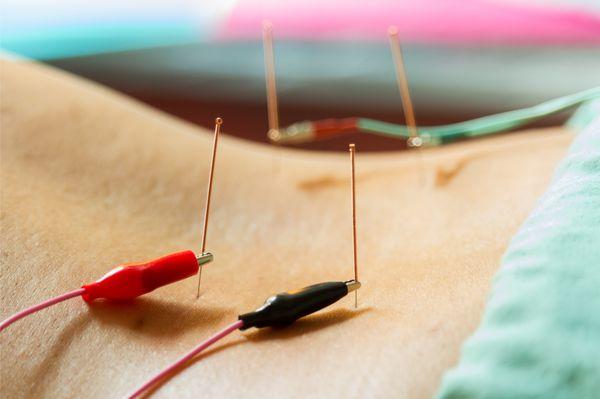 Sports Medicine Acupuncture