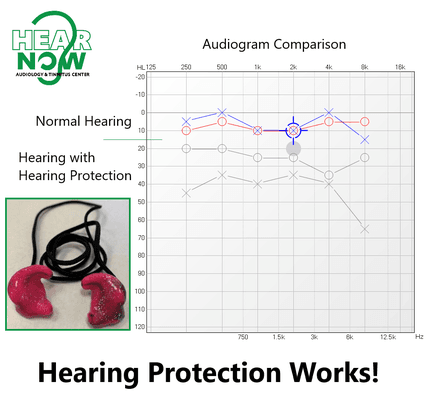 We tested a patient's hearing with and without hearing protection and found almost a 30 decibel difference. Hearing protection works!