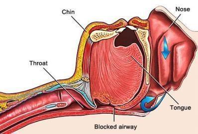 Obstructive Sleep Apnea can be deadly.