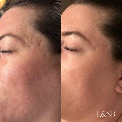 6 month microdermabrasion, peel, & custom skincare progress.