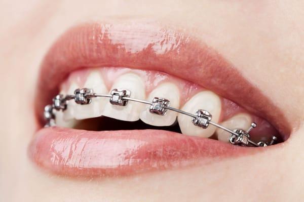 Ortho braces for young and adults